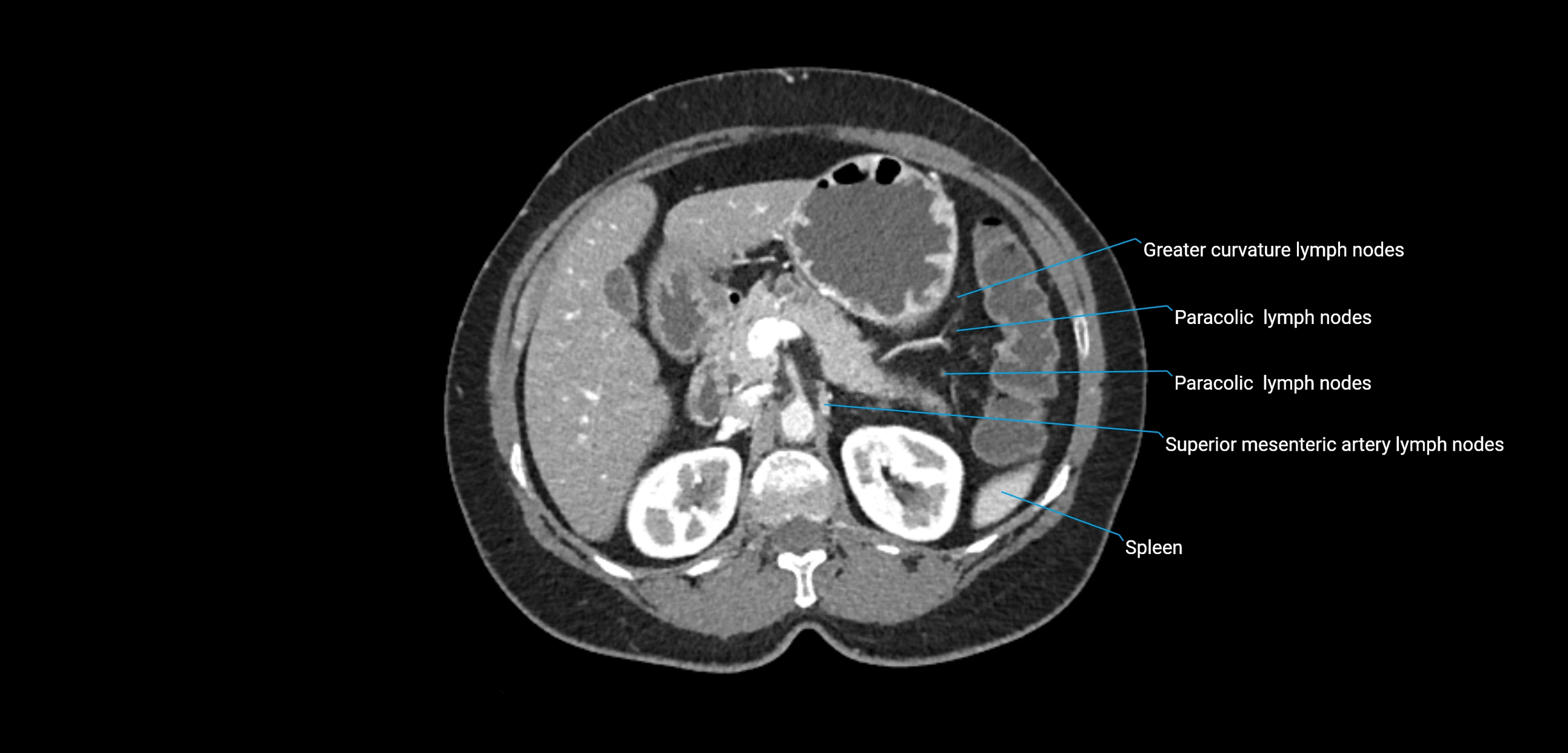 CT ct abdominal lymph nodes  axial cross sectional anatomy  enchanced radiology image -img-00002-00157.webp